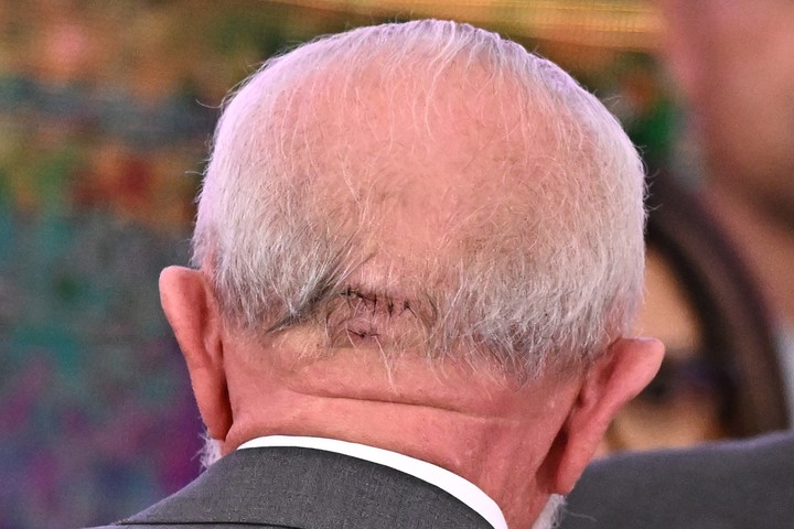 Fotografía del 25 de octubre de 2024 de una lesión en la cabeza del presidente de Brasil, Luiz Inácio Lula da Silva. Foto EFE